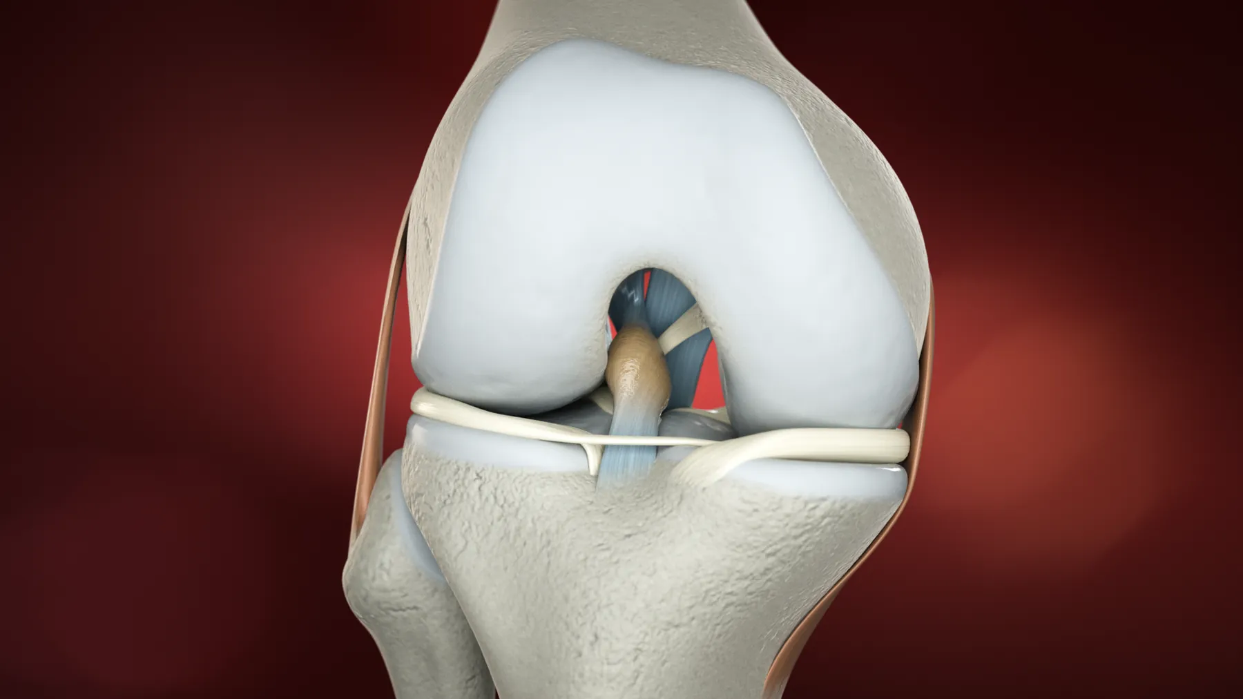 Tendoplus ACL Therapy — image 6