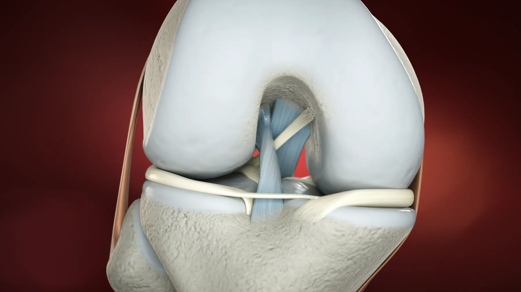 Tendoplus ACL Therapy — image 10